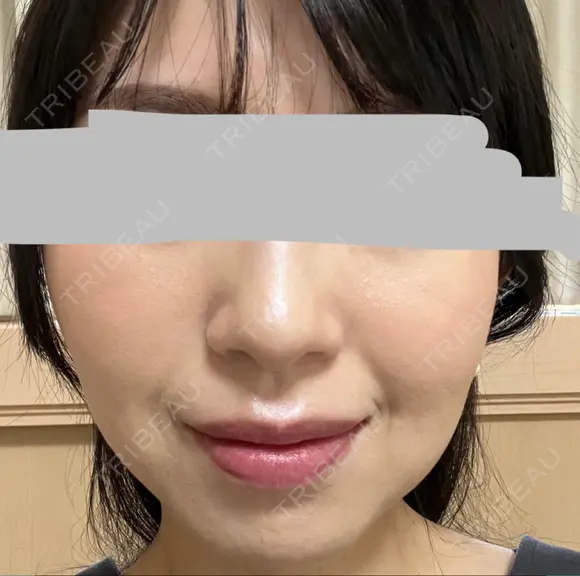 ハイフ（顔） プラチナクリニック DAY 9 メイン用