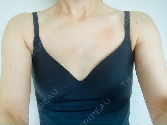 ハイフ（背中・ブラファット） 湘南美容クリニック 横浜院 AFTER メイン用