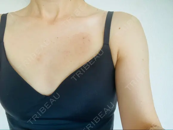 ハイフ（背中・ブラファット） 湘南美容クリニック 横浜院 DAY 169 メイン用