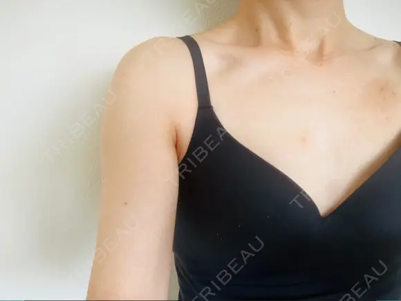 ハイフ（背中・ブラファット） 湘南美容クリニック 横浜院 DAY 169 メイン用