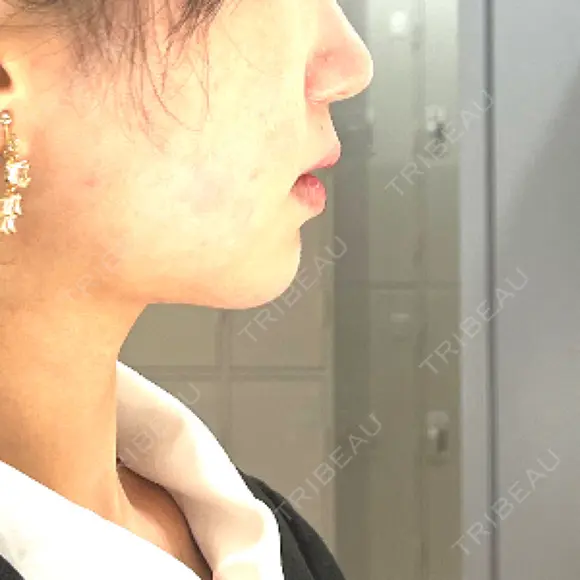 バッカルファット除去 / 脂肪吸引（顔） / ジョールファット除去 WOM CLINIC GINZA （ワム クリニック ギンザ） DAY 22 メイン用
