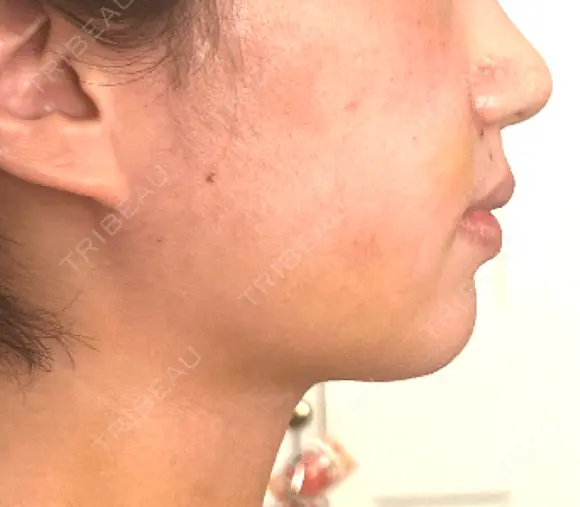 バッカルファット除去 / 脂肪吸引（顔） / ジョールファット除去 WOM CLINIC GINZA （ワム クリニック ギンザ） DAY 7 メイン用