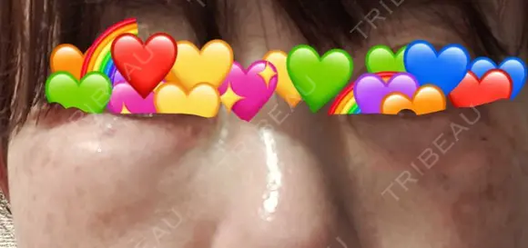 ボトックス（目尻） / スネコス YBC横浜美容外科 大宮院 DAY -354 メイン用