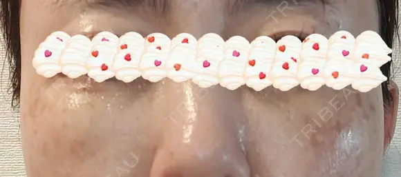 ボトックス（目尻） / スネコス YBC横浜美容外科 大宮院 DAY -354 メイン用