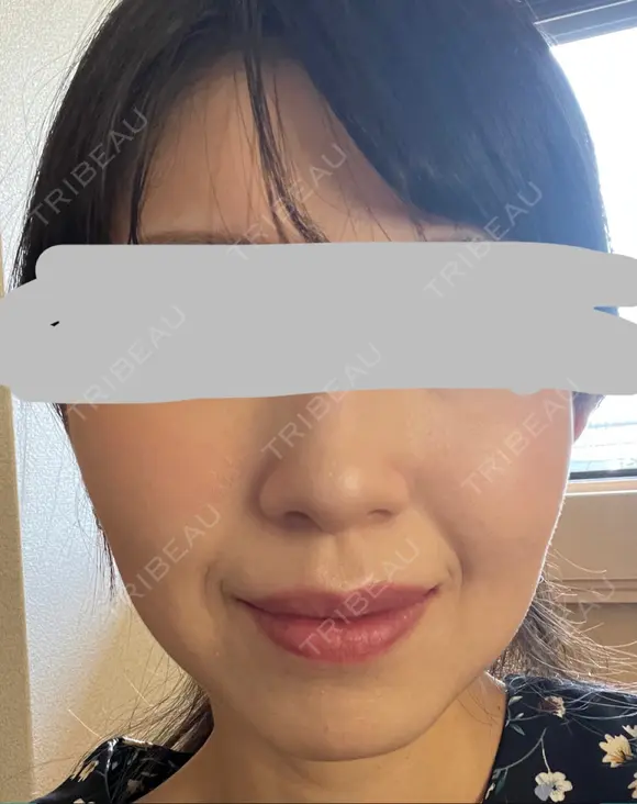 ハイフ（顔） プラチナクリニック DAY 11 メイン用