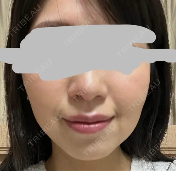 ハイフ（顔） プラチナクリニック DAY 12 メイン用