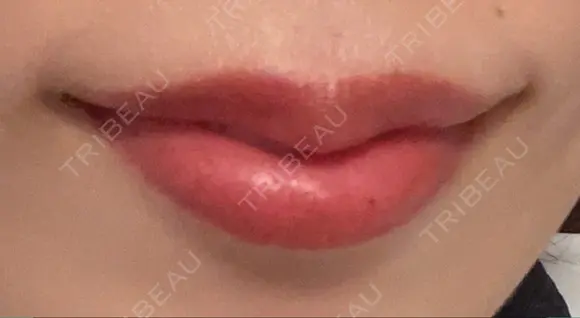 ボトックス（あご） / ヒアルロン酸注入（唇） BELINDA CLINIC（ベリンダクリニック）新宿院 DAY 32 メイン用