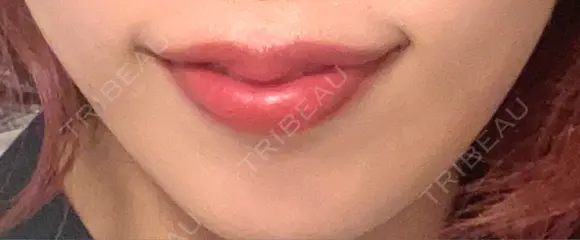 ボトックス（あご） / ヒアルロン酸注入（唇） BELINDA CLINIC（ベリンダクリニック）新宿院 DAY 72 メイン用
