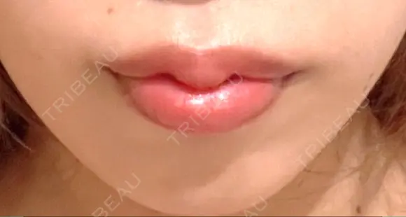 ボトックス（あご） / ヒアルロン酸注入（唇） BELINDA CLINIC（ベリンダクリニック）新宿院 AFTER メイン用