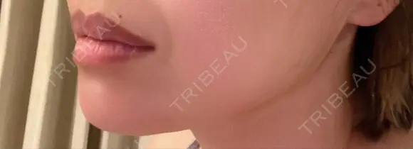 ボトックス（エラ・小顔） TCB東京中央美容外科 静岡院 DAY 4 メイン用