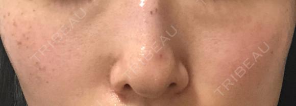 ピコスポット LOUIS CLINIC 二子玉川院【ルイクリニック】 DAY 6 メイン用