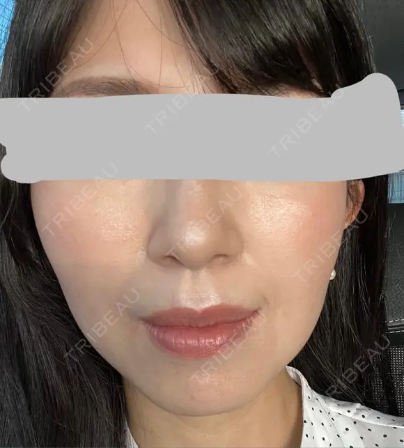 ハイフ（顔） プラチナクリニック AFTER メイン用