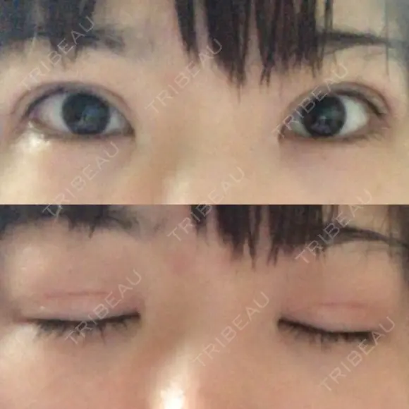 二重切開 / 目元修正 ルネッサンス美容外科医院 神戸院 DAY 51 メイン用