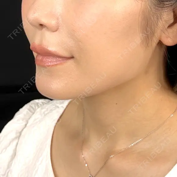 ヒアルロン酸注入（鼻翼基部） 藤・ナチュレ美容クリニック 恵比寿院 DAY 6 メイン用