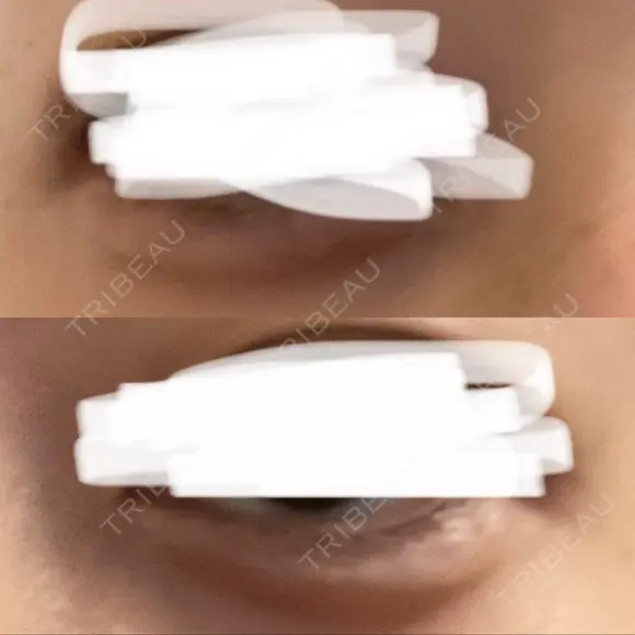 鼻翼基部形成（貴族手術） / ヒアルロン酸注入（涙袋） ルラ美容クリニック 大阪本院 DAY 0 メイン用