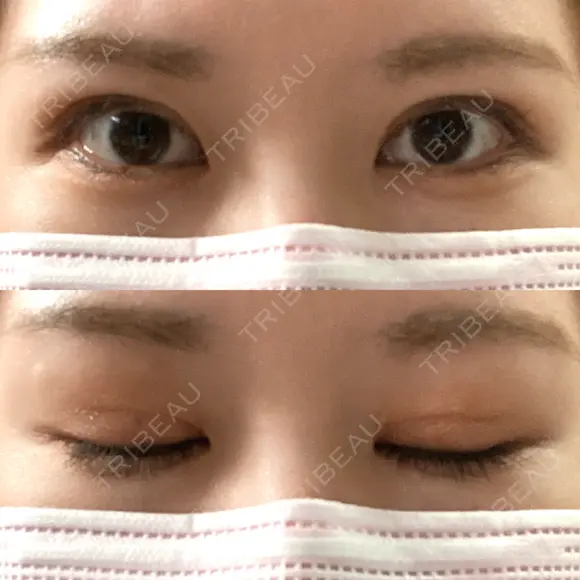 二重埋没 Olino美容外科・美容皮膚科 DAY 28 メイン用