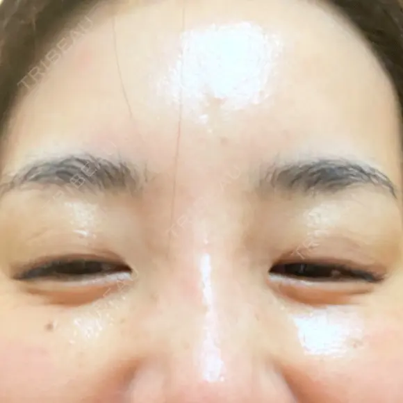 その他（目元） ももスキンケアクリニック DAY 7 メイン用