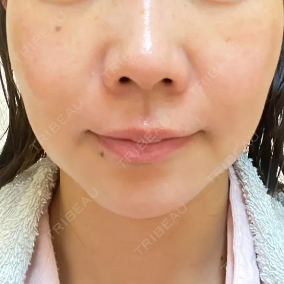 シミ取りレーザー ももスキンケアクリニック DAY 7 メイン用