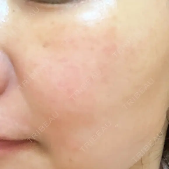 シミ取りレーザー ももスキンケアクリニック DAY 7 メイン用