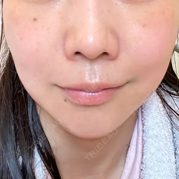 シミ取りレーザー ももスキンケアクリニック DAY 8 メイン用