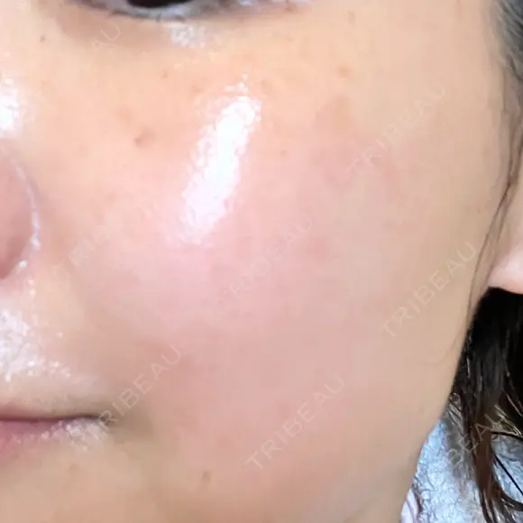 シミ取りレーザー ももスキンケアクリニック DAY 8 メイン用