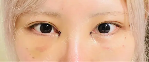 目頭切開 / 脂肪注入（目の下） WOM CLINIC GINZA （ワム クリニック ギンザ） DAY 3 メイン用