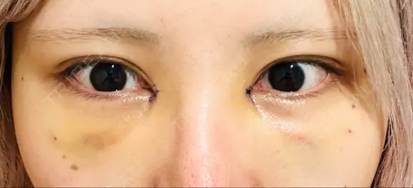 目頭切開 / 脂肪注入（目の下） WOM CLINIC GINZA （ワム クリニック ギンザ） DAY 4 メイン用