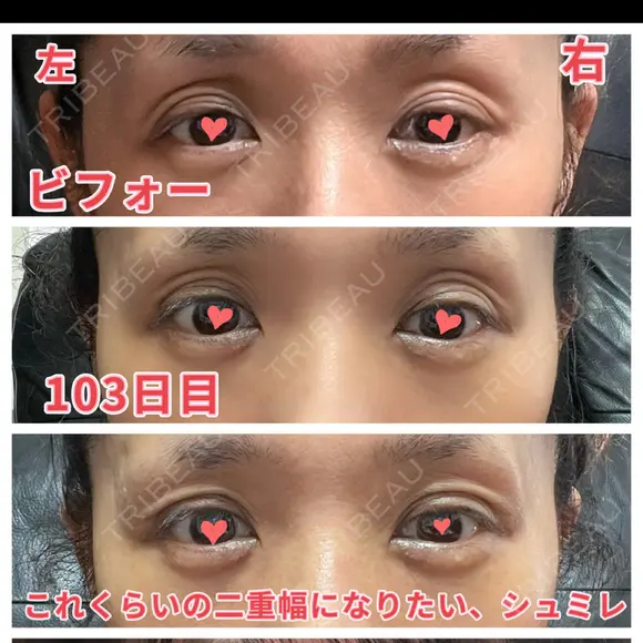 二重切開 / 眼瞼下垂（切開） / 上まぶたたるみ取り 心斎橋形成外科スキンケアクリニック DAY 104 メイン用