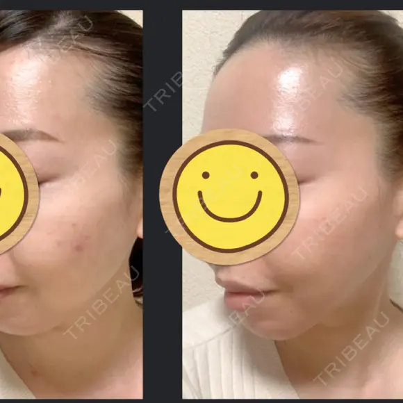 脂肪吸引（顔） / 脂肪注入（肌） / ヒアルロン酸注入（あご） / ボトックス（エラ・小顔） / ダーマペン Mods Clinic（モッズクリニック） 大阪院 AFTER メイン用