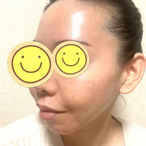 脂肪吸引（顔） / 脂肪注入（肌） / ヒアルロン酸注入（あご） / ボトックス（エラ・小顔） / ダーマペン Mods Clinic（モッズクリニック） 大阪院 DAY 176 メイン用