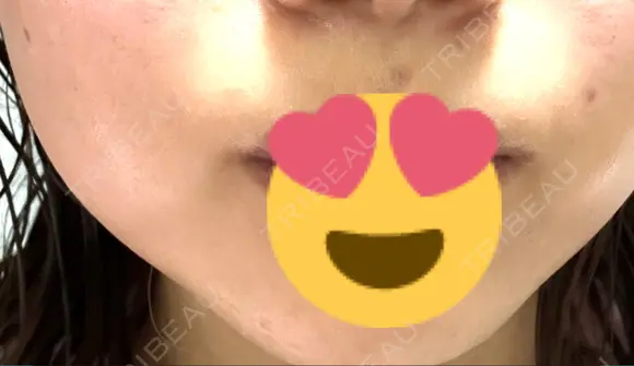 ほくろ・いぼ切除（肌） しらさぎ形成クリニック 徳島院 AFTER メイン用