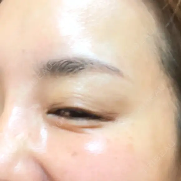 その他（目元） ももスキンケアクリニック DAY 10 メイン用