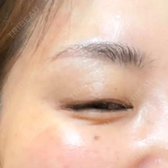 その他（目元） ももスキンケアクリニック DAY 10 メイン用