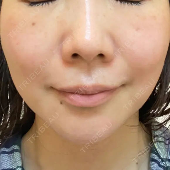 シミ取りレーザー ももスキンケアクリニック AFTER メイン用