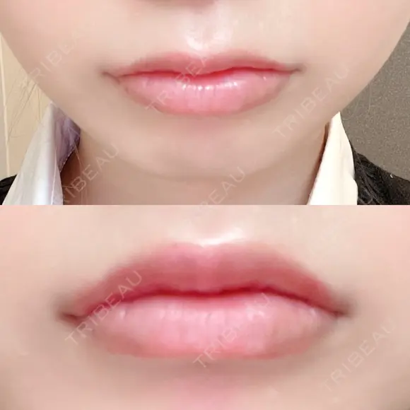 口唇縮小術 B-LINE CLINIC 池袋院 AFTER メイン用