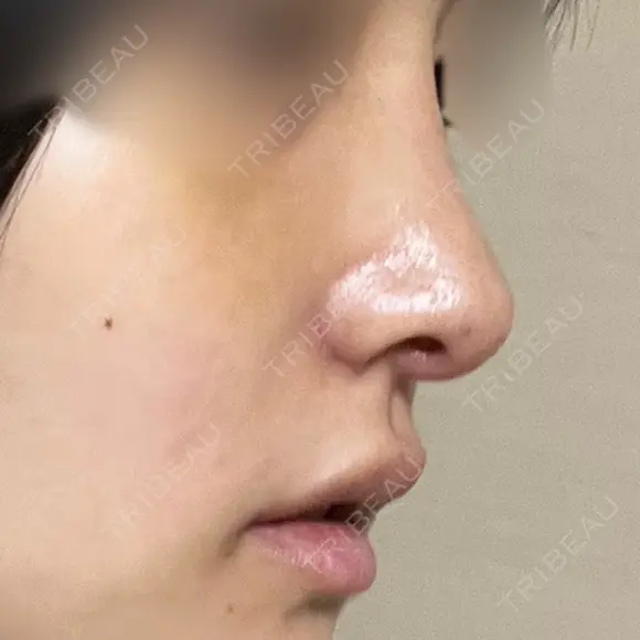 鼻尖形成（切開） / 軟骨移植 / 眉間プロテーゼ / 小鼻縮小（非切開） / 鼻柱下降・鼻唇角形成（猫手術） グローバルビューティークリニック 東京院 DAY 7 メイン用