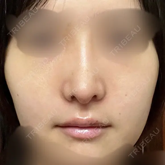 鼻尖形成（切開） / 軟骨移植 / 眉間プロテーゼ / 小鼻縮小（非切開） / 鼻柱下降・鼻唇角形成（猫手術） グローバルビューティークリニック 東京院 DAY 8 メイン用