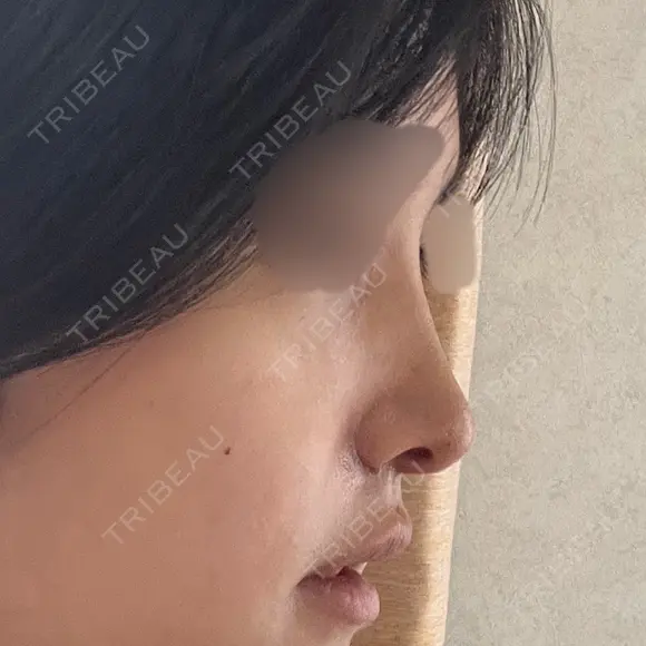 鼻尖形成（切開） / 軟骨移植 / 眉間プロテーゼ / 小鼻縮小（非切開） / 鼻柱下降・鼻唇角形成（猫手術） グローバルビューティークリニック 東京院 DAY 8 メイン用