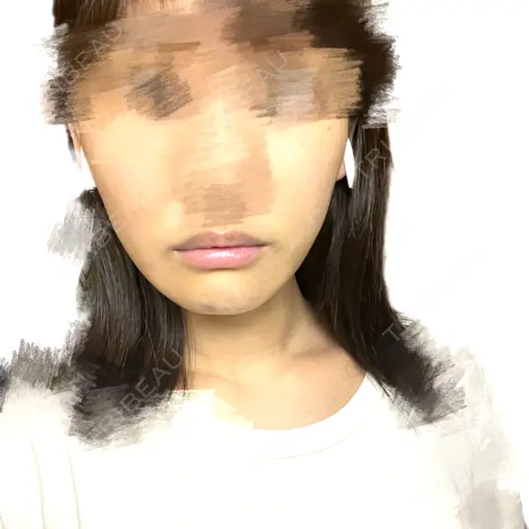 骨切り（あご） / 脂肪吸引（顔） 銀座マイアミ美容外科 DAY 265 メイン用