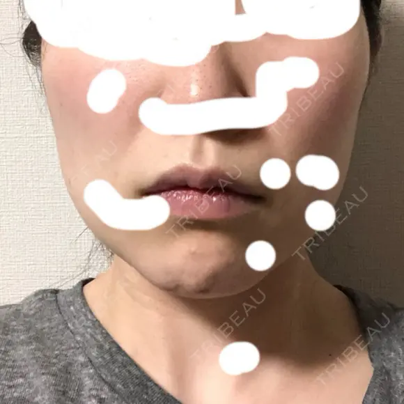 脂肪吸引（顔） / ジョールファット除去 / 脂肪注入（輪郭） WOM CLINIC GINZA （ワム クリニック ギンザ） DAY 32 メイン用