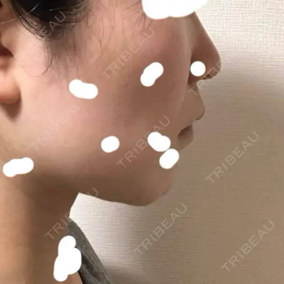 脂肪吸引（顔） / ジョールファット除去 / 脂肪注入（輪郭） WOM CLINIC GINZA （ワム クリニック ギンザ） DAY 32 メイン用