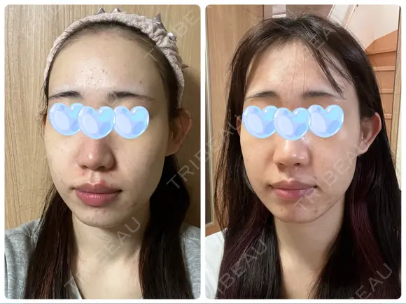 ポテンツァ レナータクリニック 立川院 AFTER メイン用