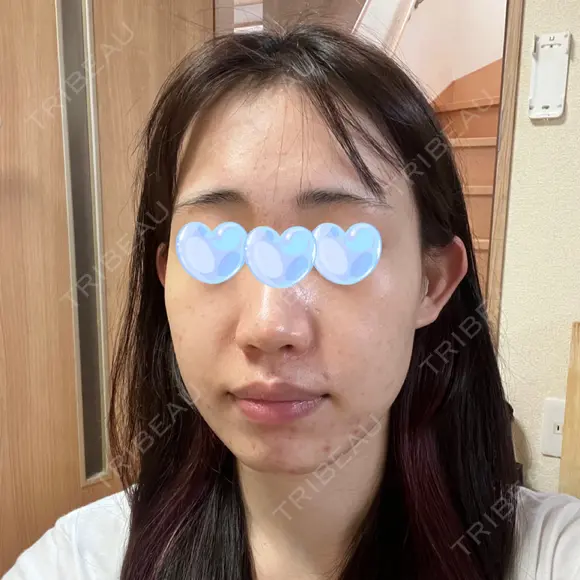 ポテンツァ レナータクリニック 立川院 DAY 17 メイン用