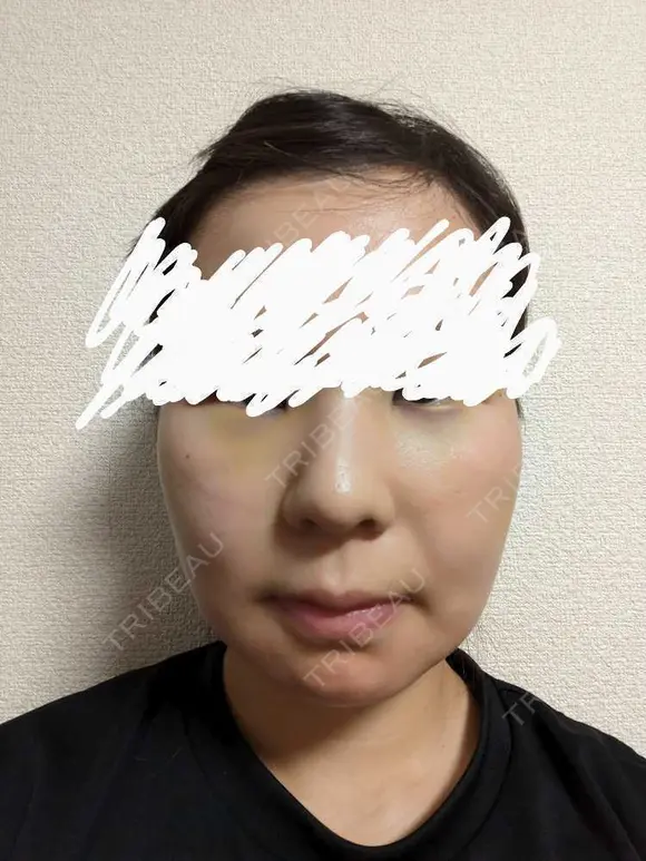 メーラーファット除去 WOM CLINIC GINZA （ワム クリニック ギンザ） DAY 2 メイン用
