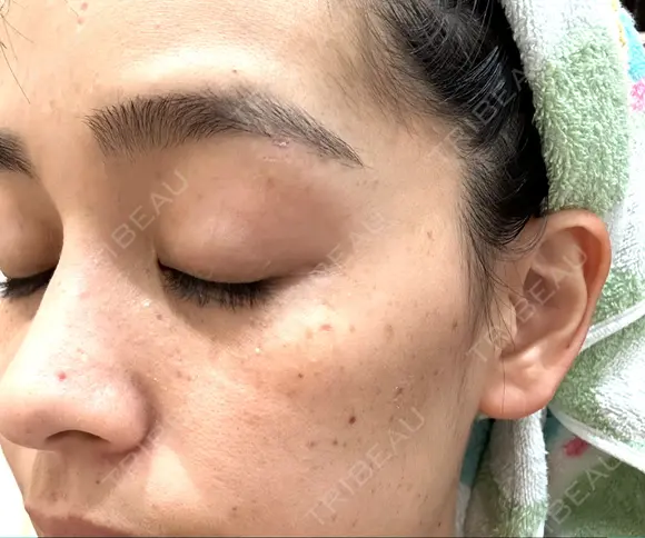 ほくろ・いぼ切除（肌） 心斎橋形成外科スキンケアクリニック DAY 8 メイン用