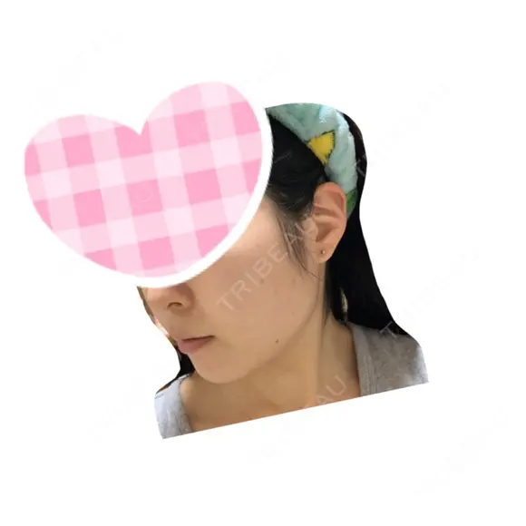 バッカルファット除去 / 脂肪吸引（顔） / ヒアルロン酸注入（涙袋） / ヒアルロン酸注入（鼻） / ヒアルロン酸注入（あご） / ボトックス（エラ・小顔） エートップ美容整形外科 DAY 16 メイン用