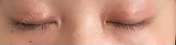 二重切開 / 目頭切開 藤・ナチュレ美容クリニック 恵比寿院 DAY 33 メイン用