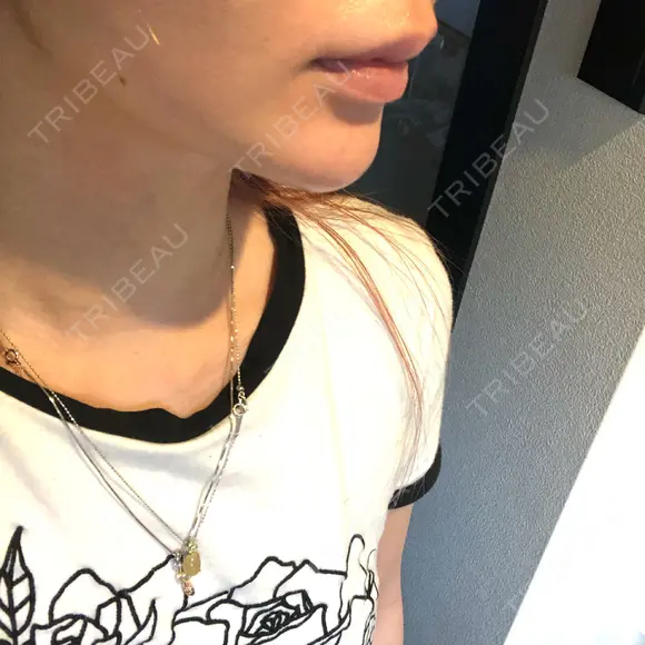 ボトックス（あご） / ヒアルロン酸注入（あご） KAGA CLINIC DAY 5 メイン用