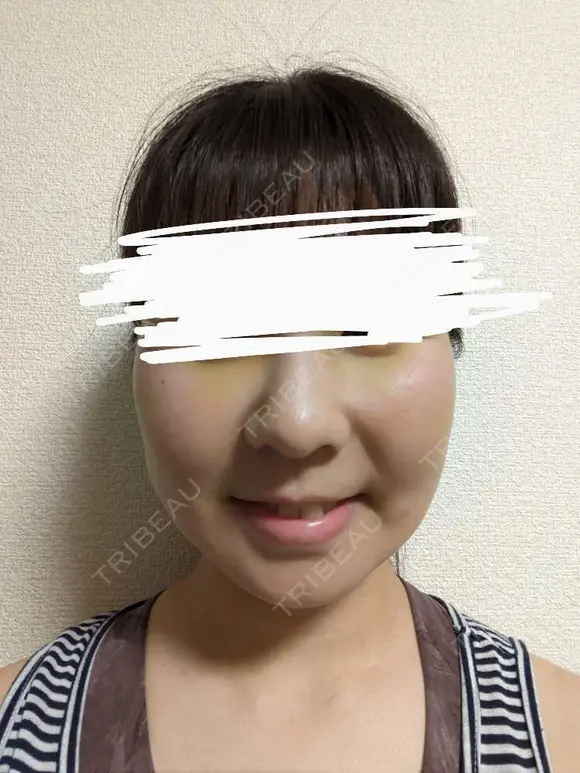 メーラーファット除去 WOM CLINIC GINZA （ワム クリニック ギンザ） DAY 5 メイン用