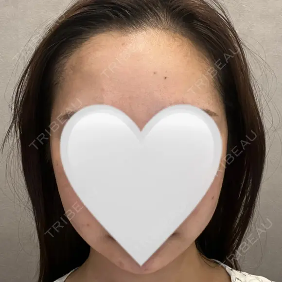 インディバ（顔） WOM SALON【術後ケア取扱いサロン】 AFTER メイン用